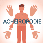 illustration absence mains pieds maladie génétique acheiropodie sante2fer